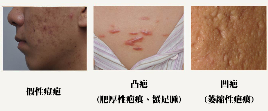 面部痘痘留下的疤痕，该如何有效修复？